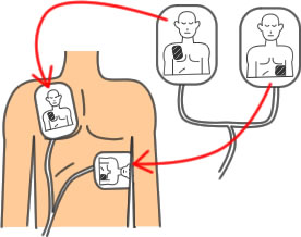 電極パッドを傷病者の胸に貼るイラスト